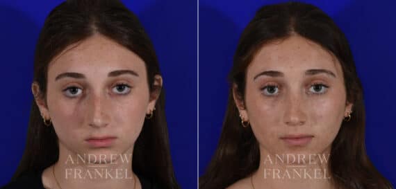 Rhinoplasty before and after photos in Beverly Hills, CA, Patient 22505
