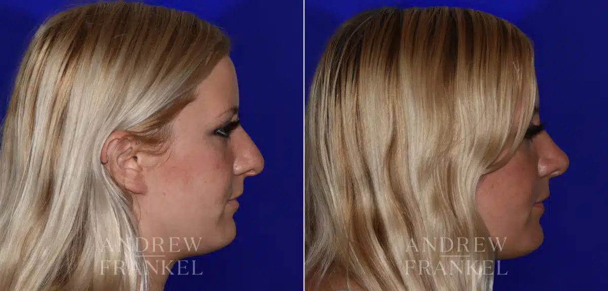 Rhinoplasty before and after photos in Beverly Hills, CA, Patient 22525