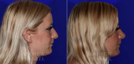 Rhinoplasty before and after photos in Beverly Hills, CA, Patient 22525