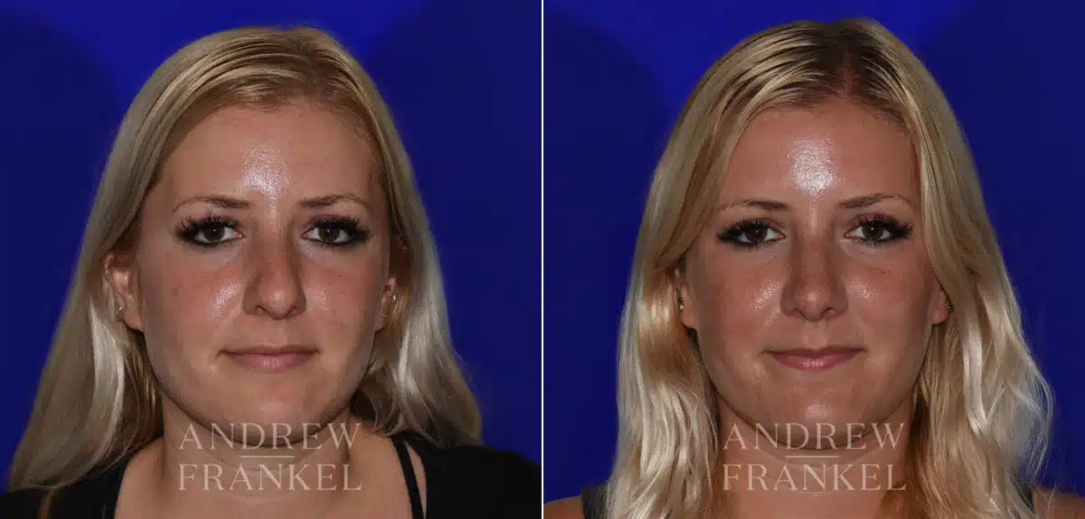 Rhinoplasty before and after photos in Beverly Hills, CA, Patient 22525