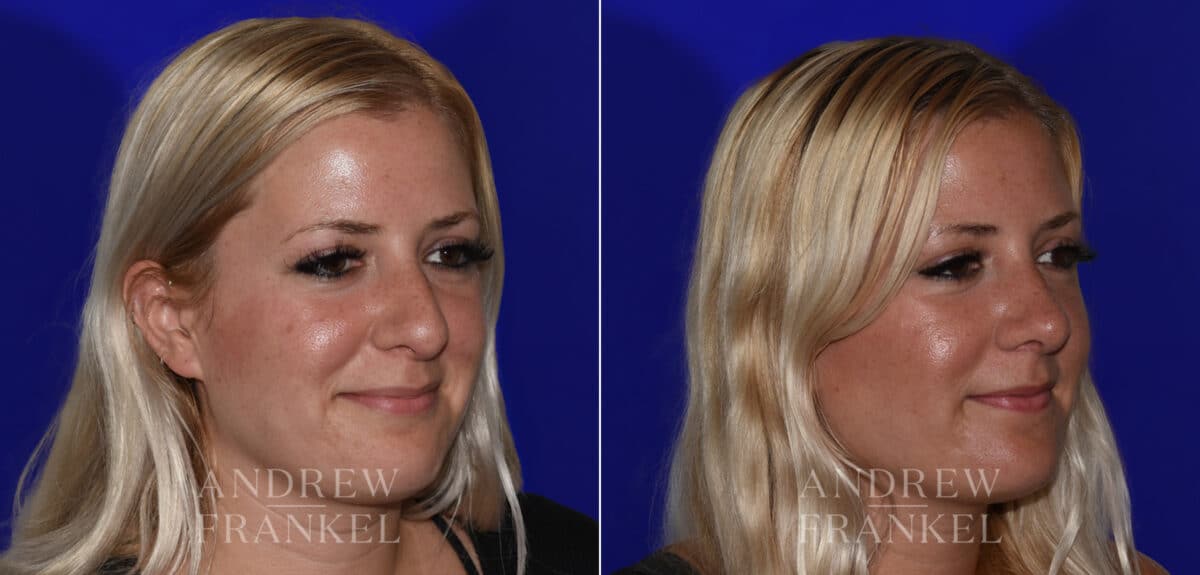 Rhinoplasty before and after photos in Beverly Hills, CA, Patient 22525