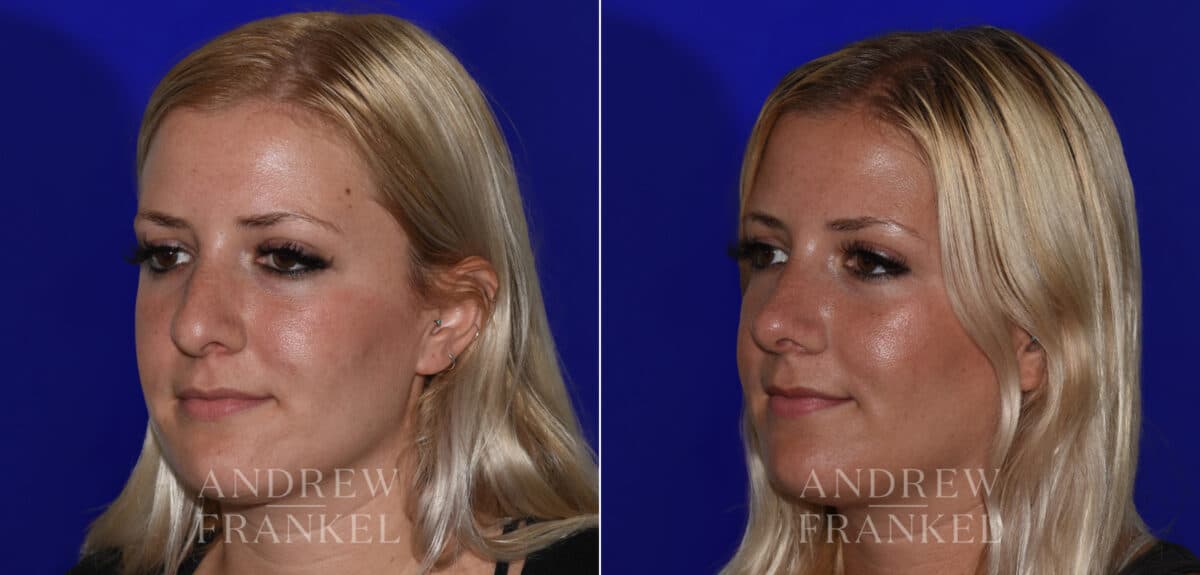 Rhinoplasty before and after photos in Beverly Hills, CA, Patient 22525