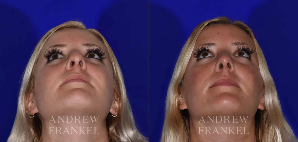 Rhinoplasty before and after photos in Beverly Hills, CA, Patient 22525