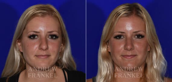 Rhinoplasty before and after photos in Beverly Hills, CA, Patient 22525