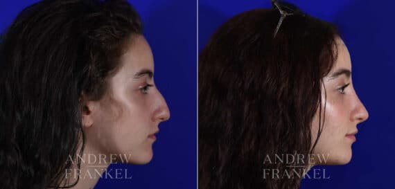 Rhinoplasty before and after photos in Beverly Hills, CA, Patient 22544