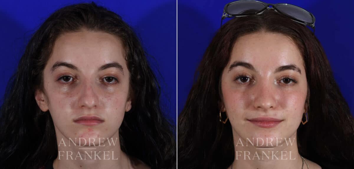 Rhinoplasty before and after photos in Beverly Hills, CA, Patient 22544