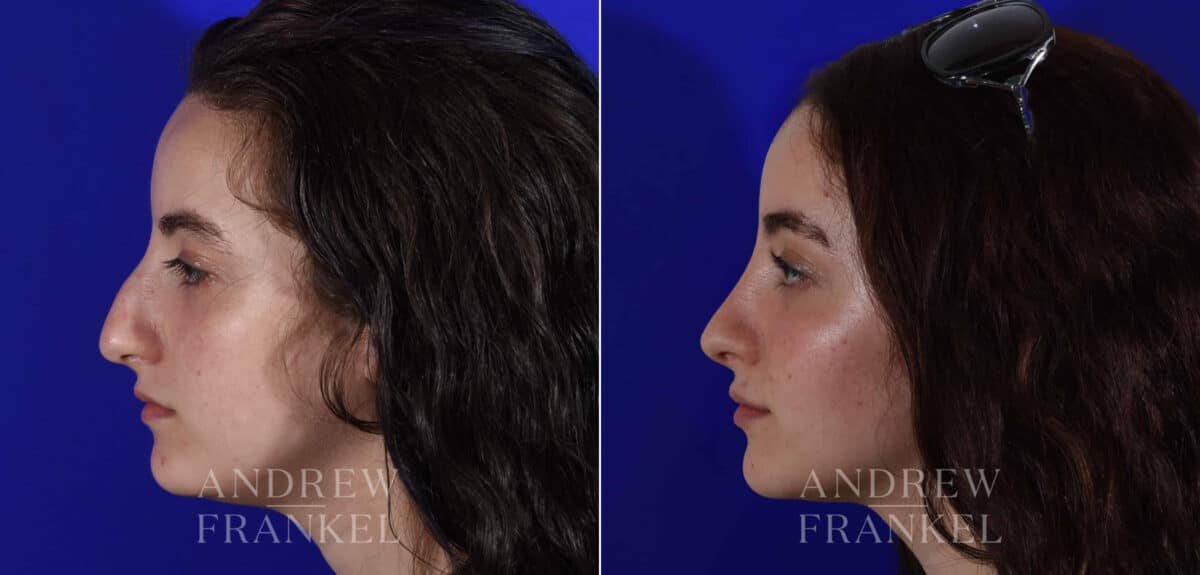 Rhinoplasty before and after photos in Beverly Hills, CA, Patient 22544