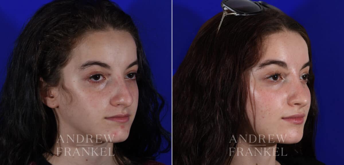 Rhinoplasty before and after photos in Beverly Hills, CA, Patient 22544