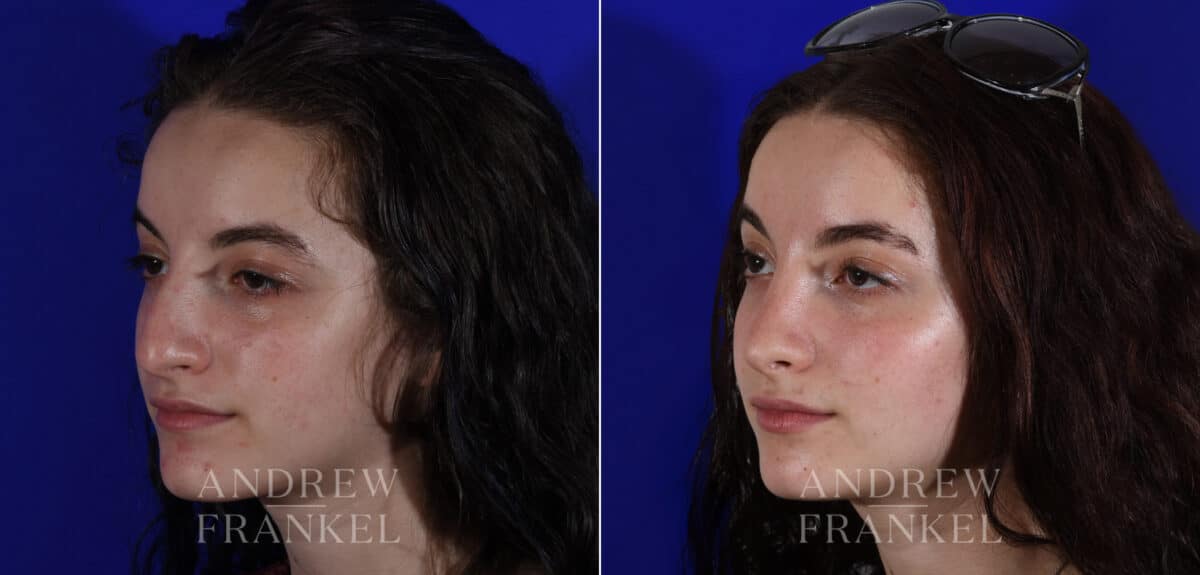 Rhinoplasty before and after photos in Beverly Hills, CA, Patient 22544