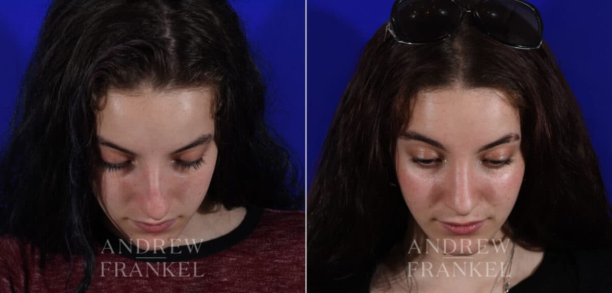 Rhinoplasty before and after photos in Beverly Hills, CA, Patient 22544