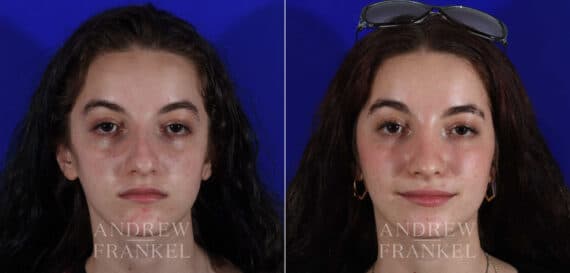 Rhinoplasty before and after photos in Beverly Hills, CA, Patient 22544