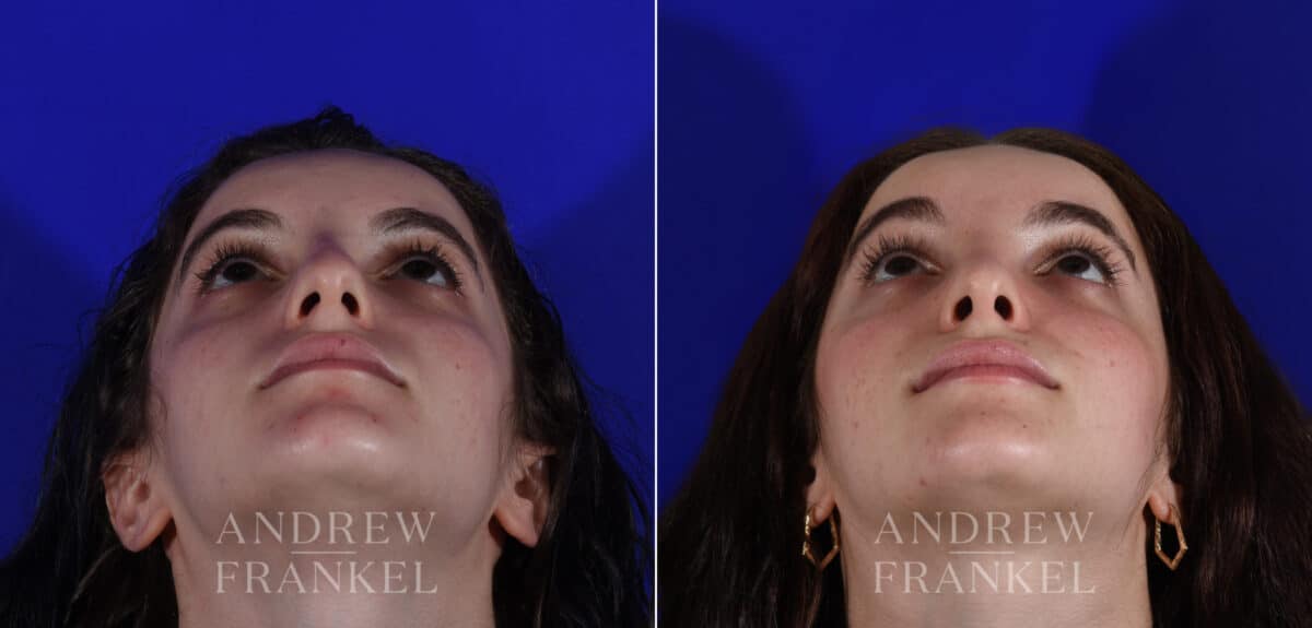 Rhinoplasty before and after photos in Beverly Hills, CA, Patient 22544