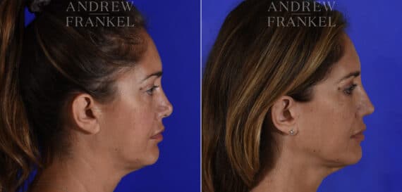 Revision Rhinoplasty before and after photos in Beverly Hills, CA, Patient 22567