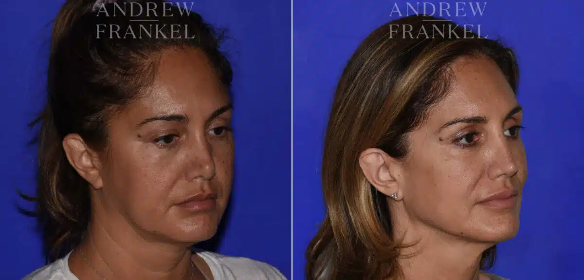 Revision Rhinoplasty before and after photos in Beverly Hills, CA, Patient 22567