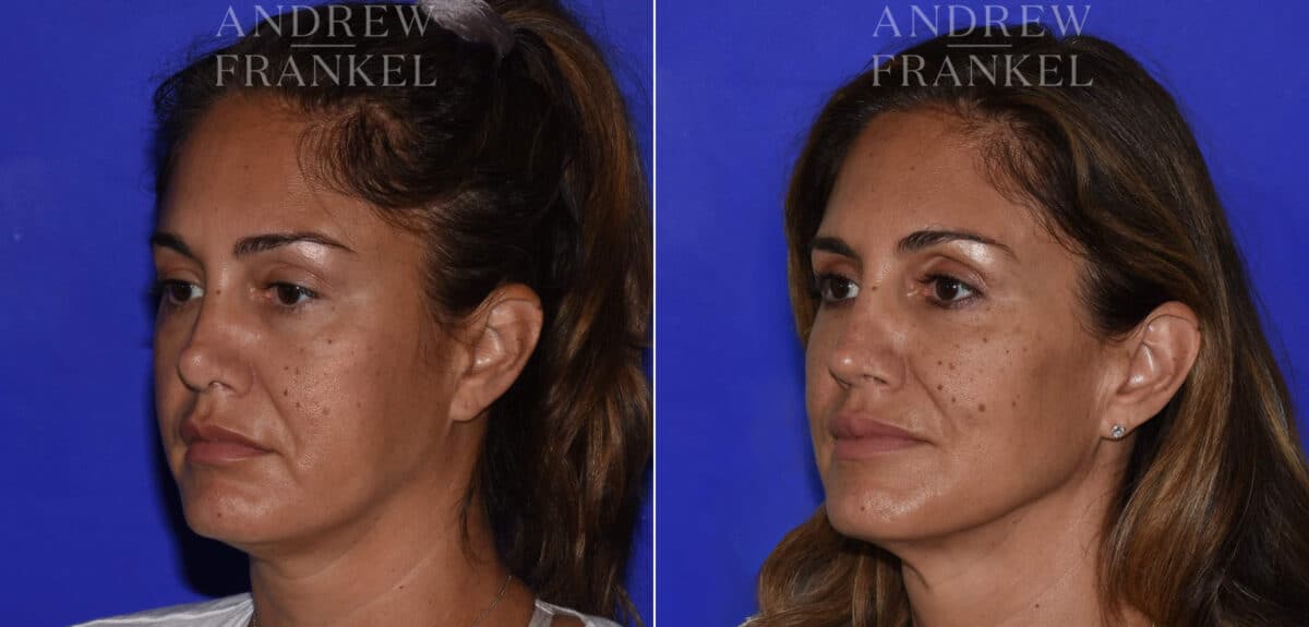 Revision Rhinoplasty before and after photos in Beverly Hills, CA, Patient 22567