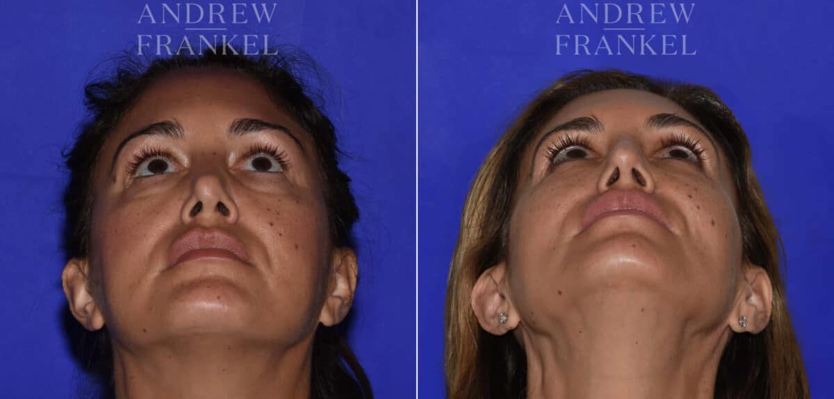 Revision Rhinoplasty before and after photos in Beverly Hills, CA, Patient 22567