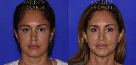 Revision Rhinoplasty before and after photos in Beverly Hills, CA, Patient 22567