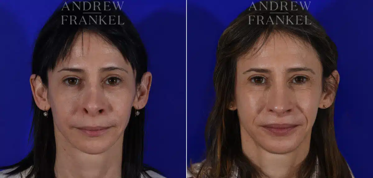 Revision Rhinoplasty before and after photos in Beverly Hills, CA, Patient 22586