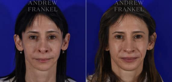 Revision Rhinoplasty before and after photos in Beverly Hills, CA, Patient 22586
