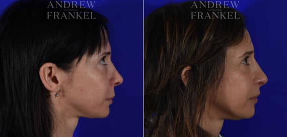 Revision Rhinoplasty before and after photos in Beverly Hills, CA, Patient 22586