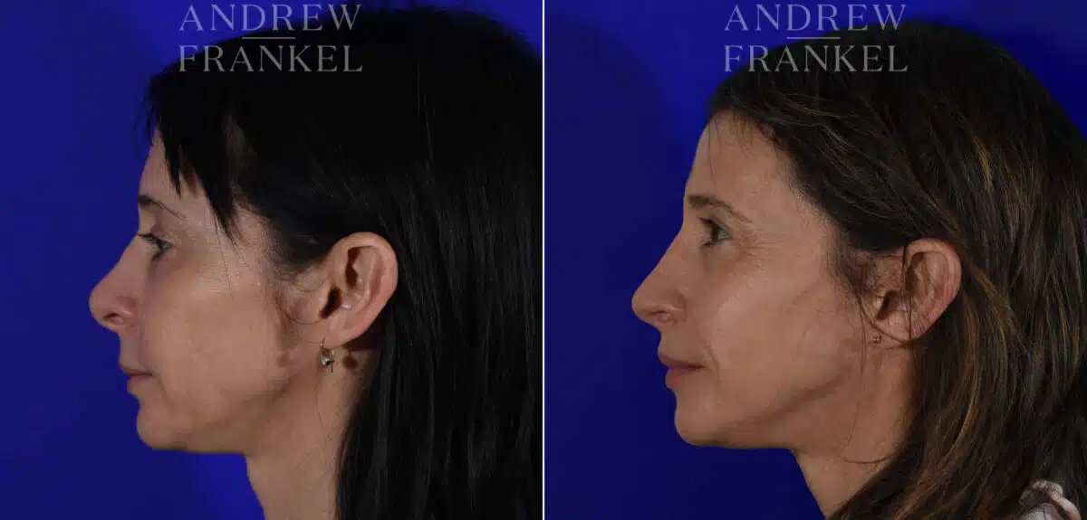 Revision Rhinoplasty before and after photos in Beverly Hills, CA, Patient 22586