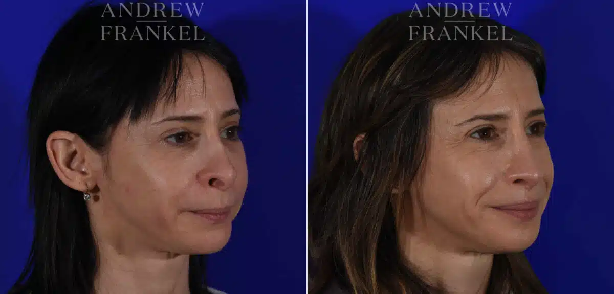 Revision Rhinoplasty before and after photos in Beverly Hills, CA, Patient 22586