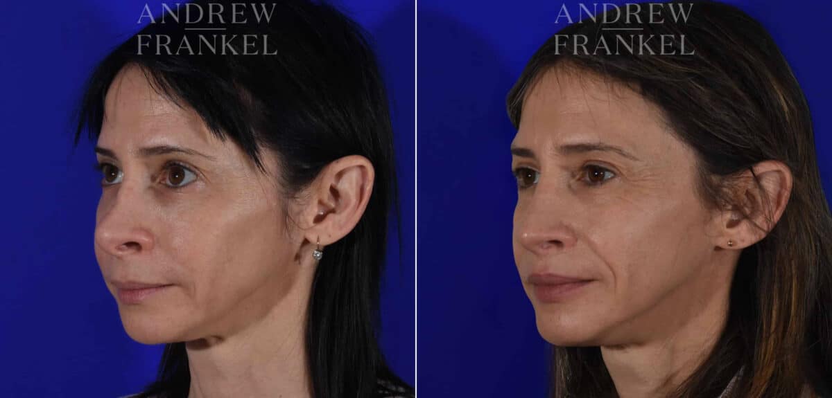 Revision Rhinoplasty before and after photos in Beverly Hills, CA, Patient 22586