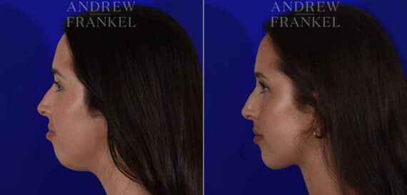 Jawline Contouring before and after photos in Beverly Hills, CA, Patient 22602