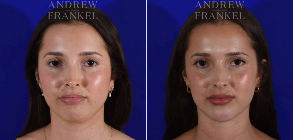 Jawline Contouring before and after photos in Beverly Hills, CA, Patient 22602