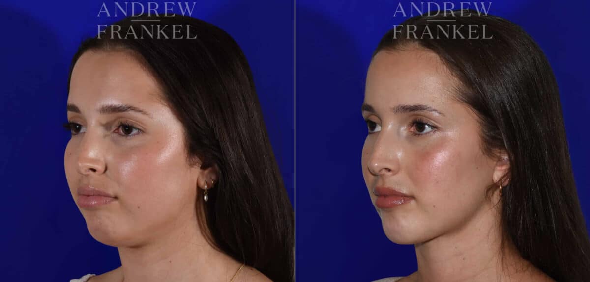 Jawline Contouring before and after photos in Beverly Hills, CA, Patient 22602