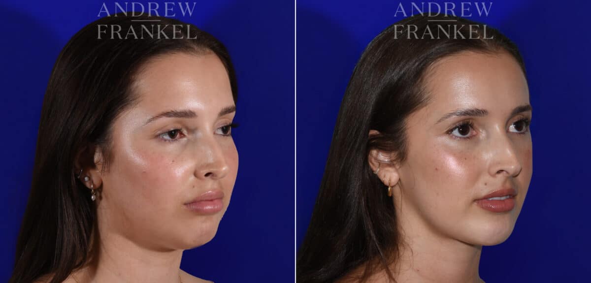 Jawline Contouring before and after photos in Beverly Hills, CA, Patient 22602