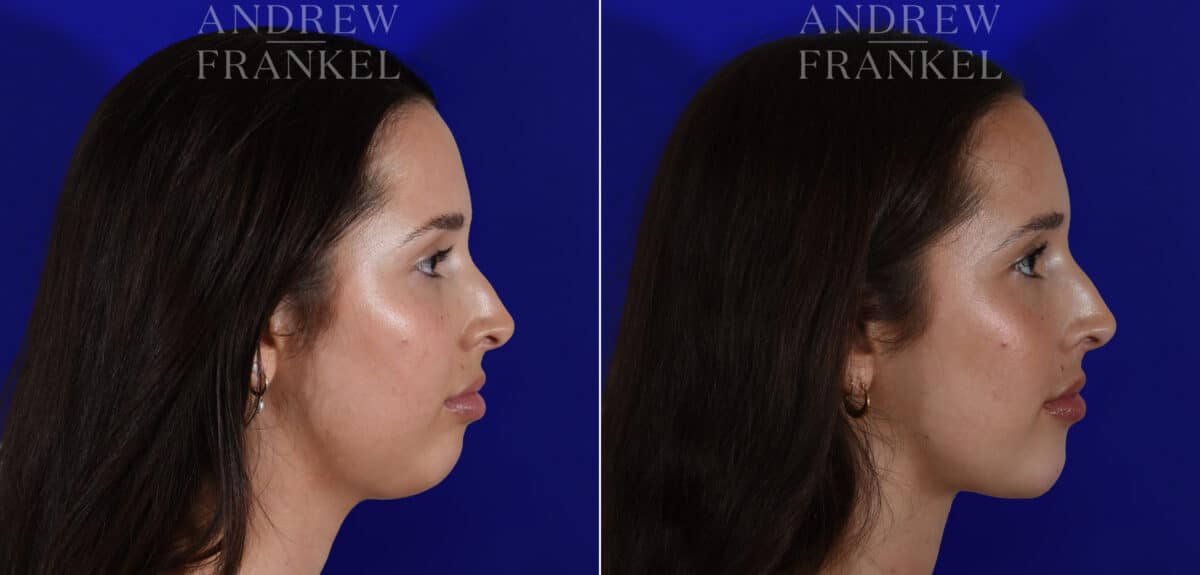 Jawline Contouring before and after photos in Beverly Hills, CA, Patient 22602