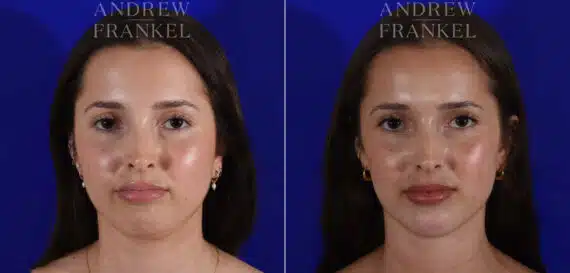 Jawline Contouring before and after photos in Beverly Hills, CA, Patient 22602