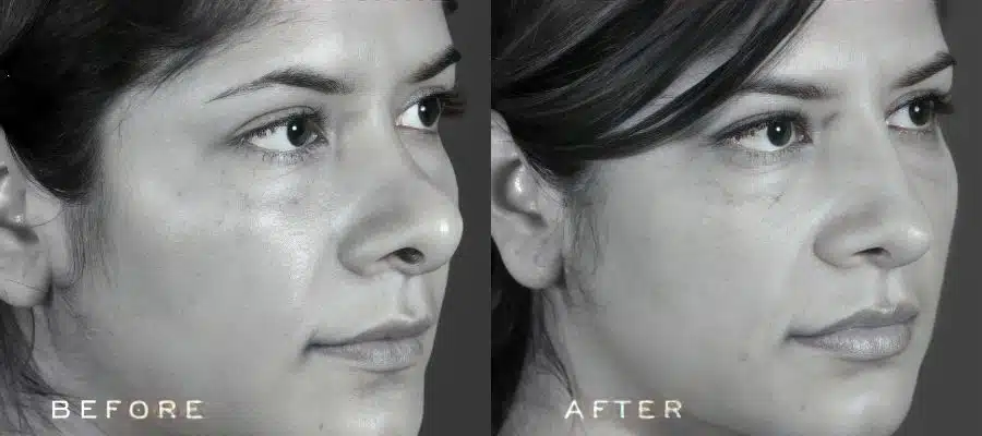 Side-by-side before and after rhinoplasty comparison showing refined nasal structure and balanced facial profile