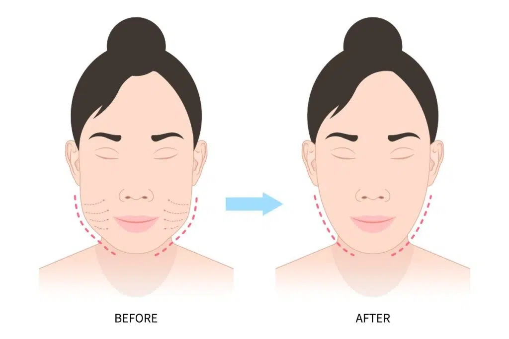 Illustration showing before and after results of buccal fat removal with slimmer cheeks and defined jawline