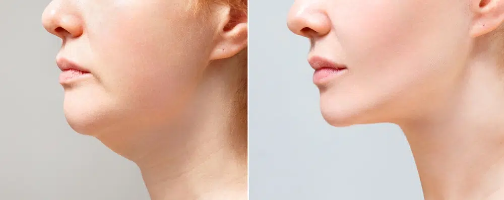 Side profile comparison before and after chin augmentation and rhinoplasty showing improved facial balance and definition