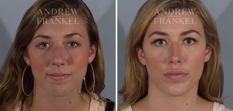 Non-Surgical Jawline Enhancement galleries