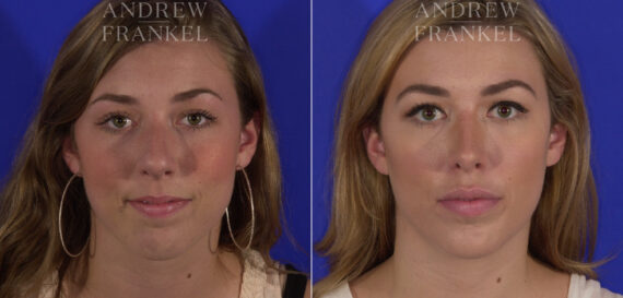 Non-Surgical Jawline Enhancement before and after photos in Beverly Hills, CA, Patient 23544