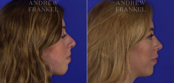 Non-Surgical Jawline Enhancement before and after photos in Beverly Hills, CA, Patient 23544