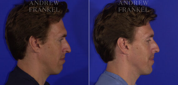 Non-Surgical Jawline Enhancement before and after photos in Beverly Hills, CA, Patient 23551