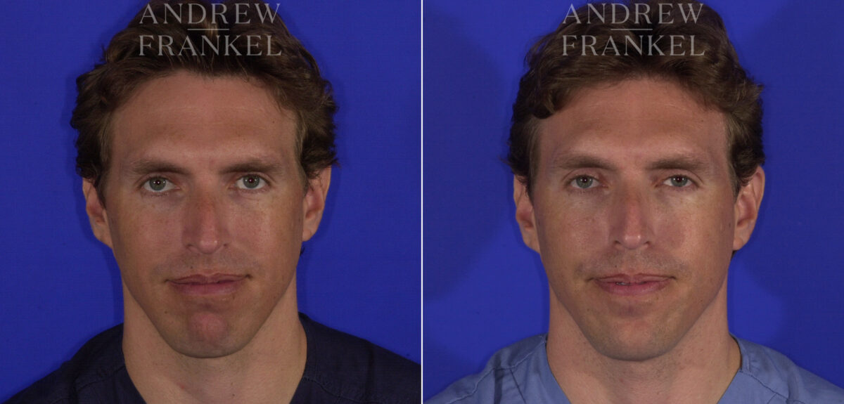 Non-Surgical Jawline Enhancement before and after photos in Beverly Hills, CA, Patient 23551