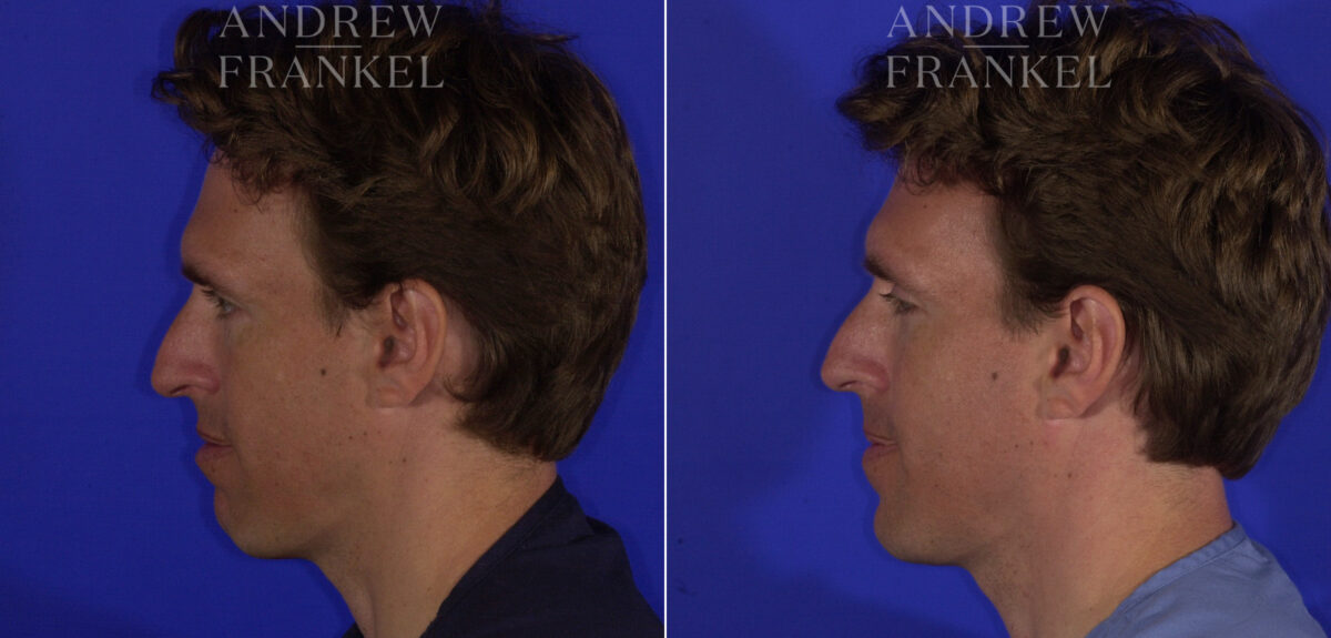 Non-Surgical Jawline Enhancement before and after photos in Beverly Hills, CA, Patient 23551