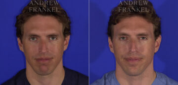 Non-Surgical Jawline Enhancement before and after photos in Beverly Hills, CA, Patient 23551