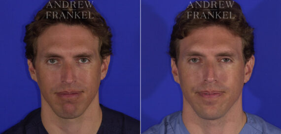 Non-Surgical Jawline Enhancement before and after photos in Beverly Hills, CA, Patient 23551