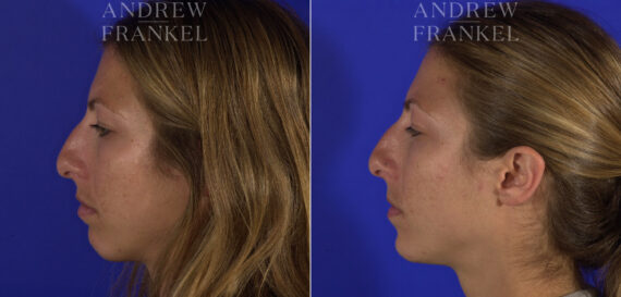 Non-Surgical Jawline Enhancement before and after photos in Beverly Hills, CA, Patient 23564