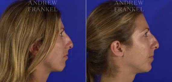 Non-Surgical Jawline Enhancement before and after photos in Beverly Hills, CA, Patient 23564