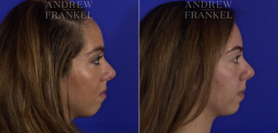 Non-Surgical Jawline Enhancement before and after photos in Beverly Hills, CA, Patient 23571