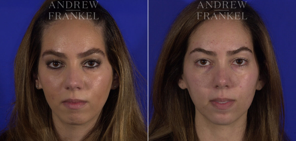 Non-Surgical Jawline Enhancement before and after photos in Beverly Hills, CA, Patient 23571