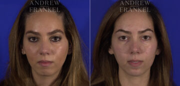 Non-Surgical Jawline Enhancement before and after photos in Beverly Hills, CA, Patient 23571