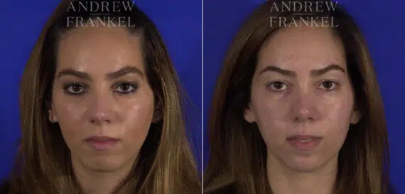 Non-Surgical Jawline Enhancement before and after photos in Beverly Hills, CA, Patient 23571